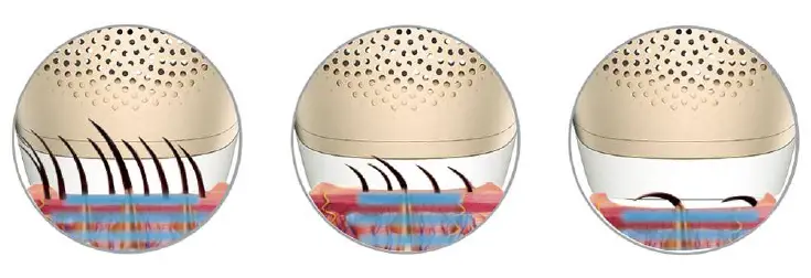 Yachyee-Laser-Hair-Removal-Device-FIG-1