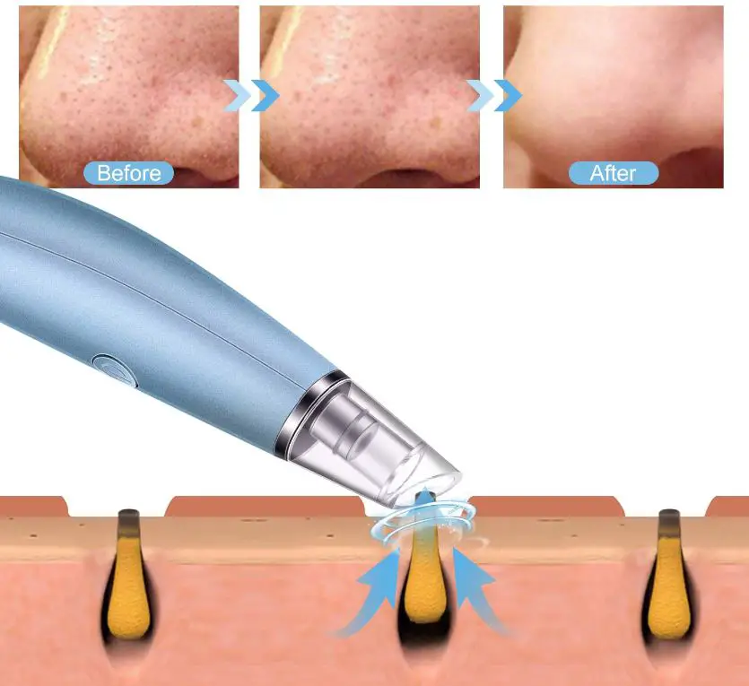 Alin-&-Alan-B08KDBR3LK-Blackhead-Remover-Vacuum-Pore-Cleaner-img-2