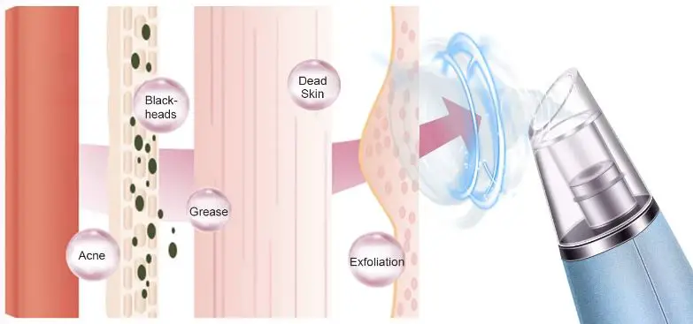 Alin-&-Alan-B08KDBR3LK-Blackhead-Remover-Vacuum-Pore-Cleaner-img-3