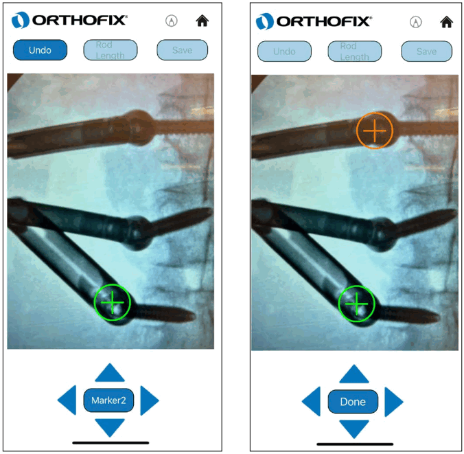 ORTHOFIX OFIX MIS App Workflow - Marker 2
