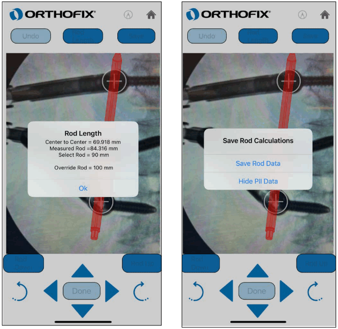 ORTHOFIX OFIX MIS App Workflow - Rod Calculations