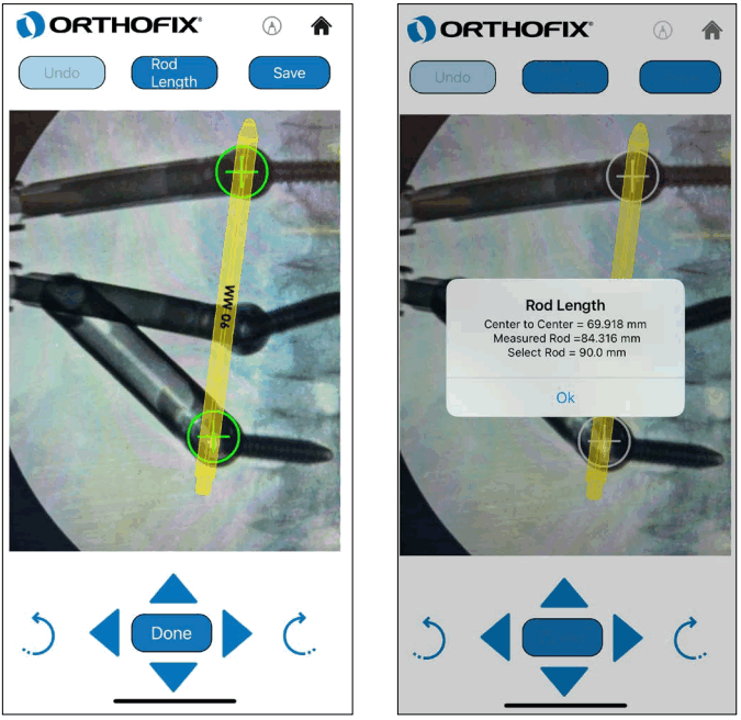 ORTHOFIX OFIX MIS App Workflow - Rod Overlay