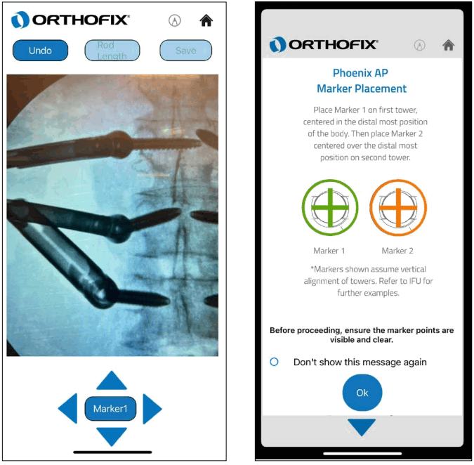 ORTHOFIX OFIX MIS App Workflow - Start Marker 1