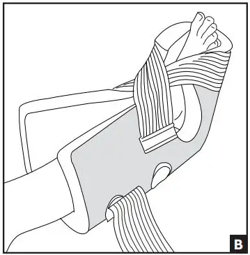 DJO PROCARE Heel Relief Boot Instructions - Take one of the straps located under the forefoot and bring it over the top of the foot and secure to the opposite side of the boot