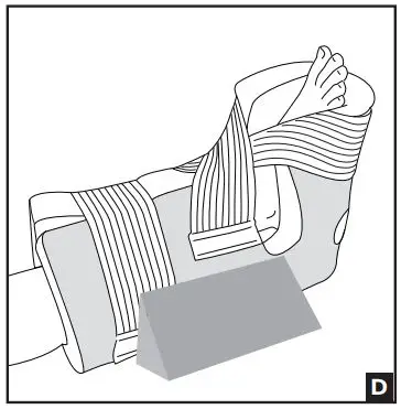 DJO PROCARE Heel Relief Boot Instructions - To control external hip rotation, place the velcro hook side of wedge to the lateral exterior side of boot