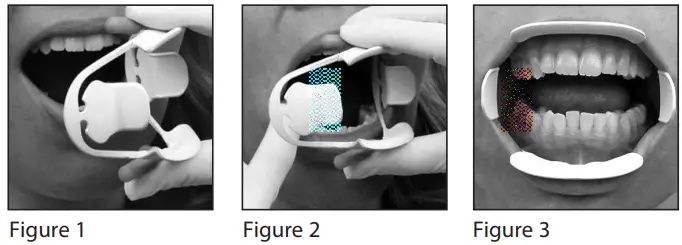 premier-dentalco-ComfortView-Lip-and-Cheek-Retractor-FIG-2