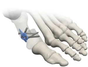 DJO M.I.B. Plating System