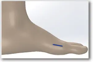 M.I.B. Plating System - SURGICAL TECHNIQUE - STEP 1