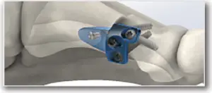 M.I.B. Plating System - SURGICAL TECHNIQUE - STEP 14