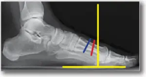M.I.B. Plating System - SURGICAL TECHNIQUE - STEP 2