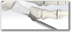 M.I.B. Plating System - SURGICAL TECHNIQUE - STEP 4