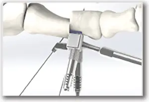 M.I.B. Plating System - SURGICAL TECHNIQUE - STEP 5