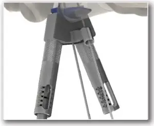 M.I.B. Plating System - SURGICAL TECHNIQUE - STEP 6