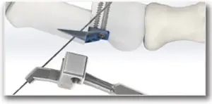 M.I.B. Plating System - SURGICAL TECHNIQUE - STEP 9