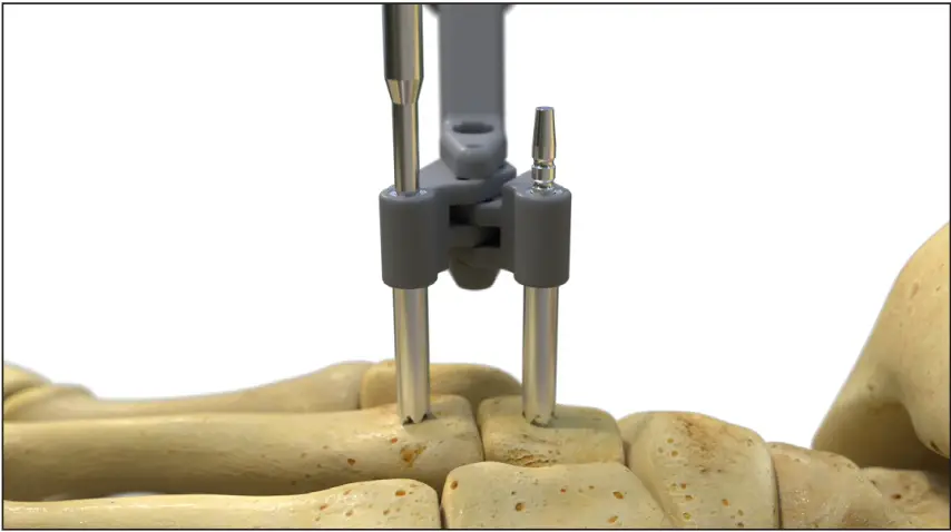 Using the Drill to create a pilot hole in the bone.
