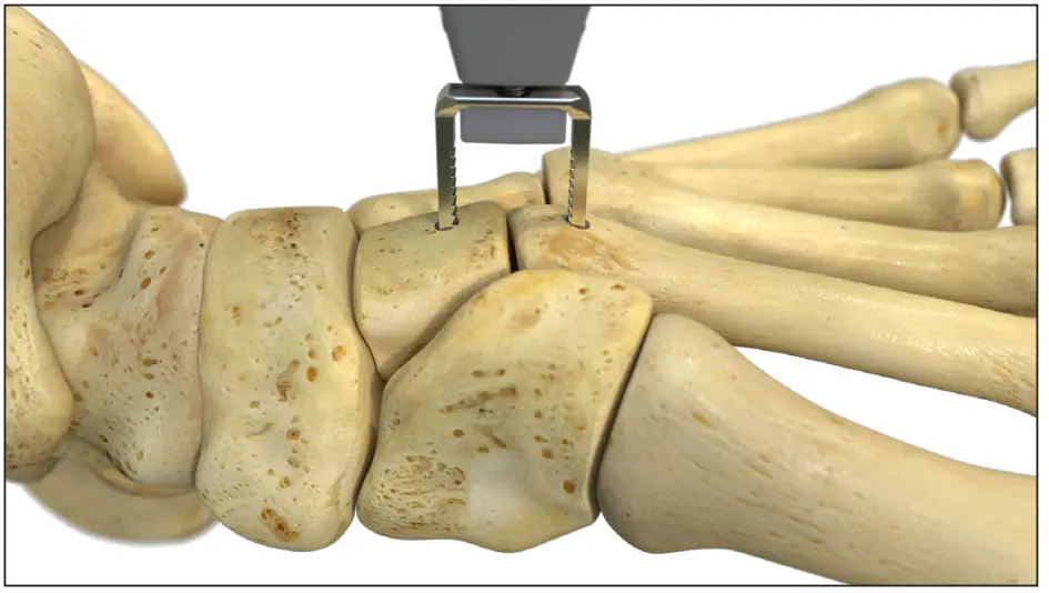 Drill Guide before inserting the implant.