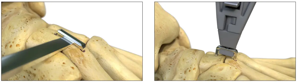 Removal and reinsertion