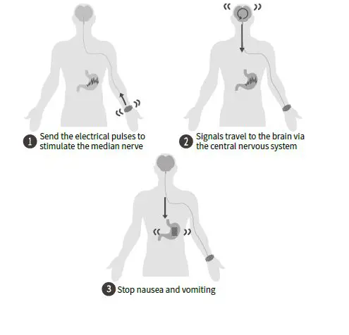 EmeTerm YF-ZTY-E1-BLACK Motion Sickness Nausea Wristband fig 6