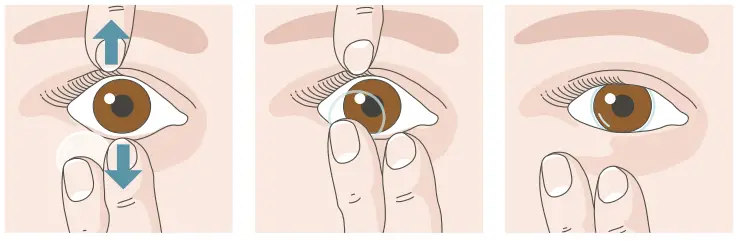 CooperVision Contact Lens Wear - fig4