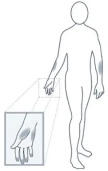 bioland G-425-3 Blood Glucose Meter - Alternative site testing