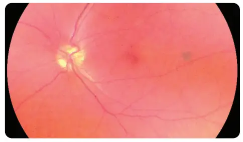 VOLK VISTA VIEW Handheld Retinal Camera - TROUBLESHOOTING IMAGES 1