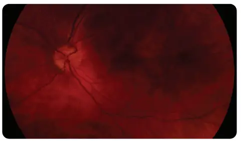 VOLK VISTA VIEW Handheld Retinal Camera - TROUBLESHOOTING IMAGES 2