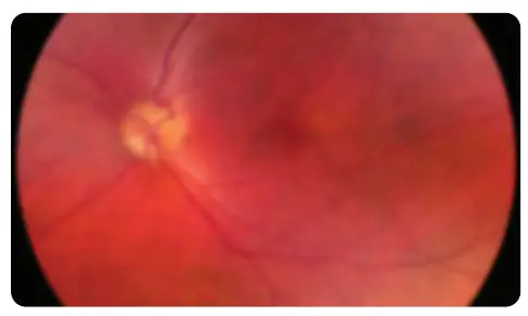 VOLK VISTA VIEW Handheld Retinal Camera - TROUBLESHOOTING IMAGES 3