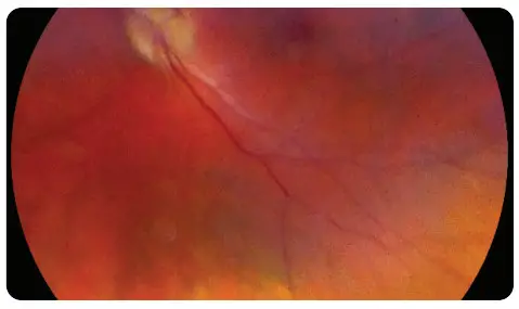 VOLK VISTA VIEW Handheld Retinal Camera - TROUBLESHOOTING IMAGES 4