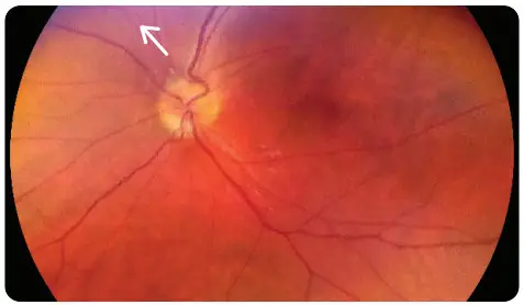 VOLK VISTA VIEW Handheld Retinal Camera - TROUBLESHOOTING IMAGES 5