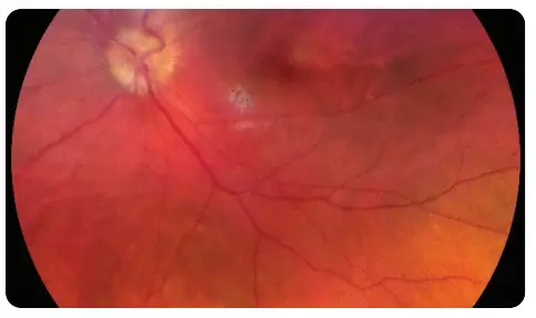 VOLK VISTA VIEW Handheld Retinal Camera - TROUBLESHOOTING IMAGES 6