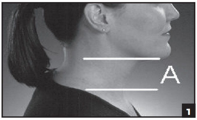 DJO Procare One Piece Cervical Collar - FIG1