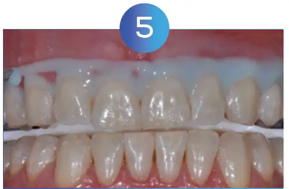 Whitening Instructions