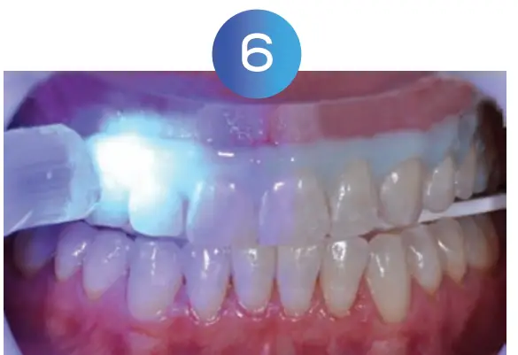 Whitening Instructions