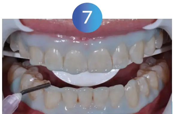 Whitening Instructions