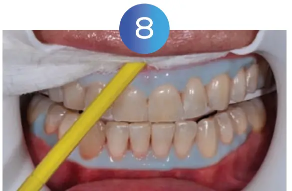 Whitening Instructions