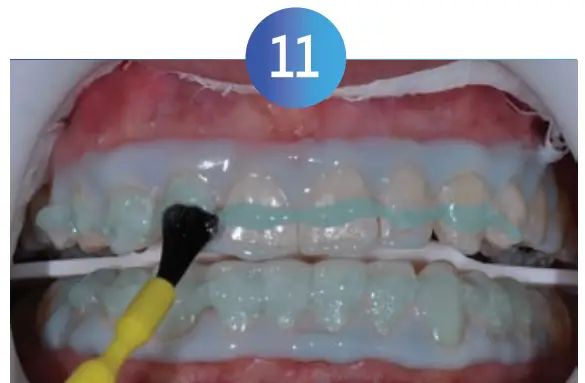 Whitening Instructions