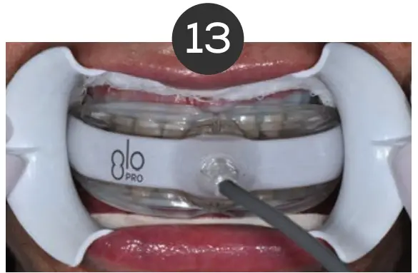 Whitening Instructions