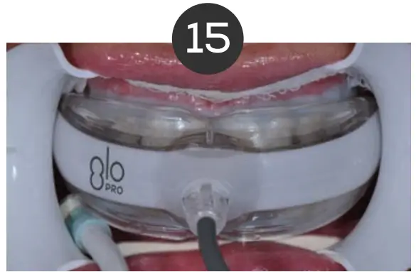 Whitening Instructions