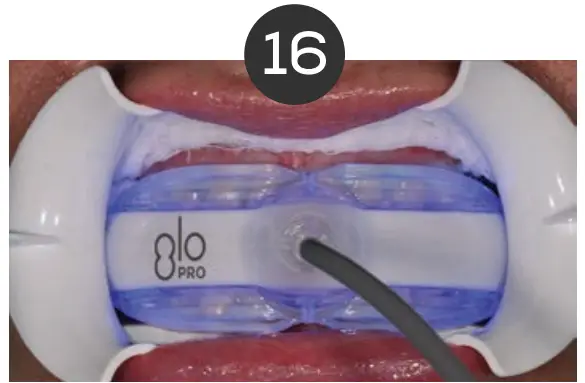 Whitening Instructions