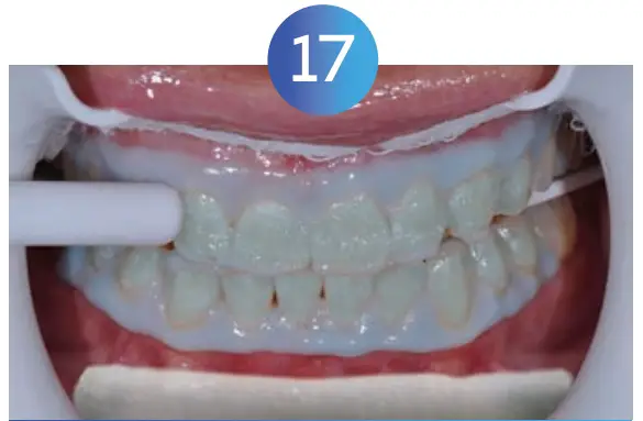 Teeth Whitening Instructions