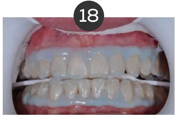 Teeth Whitening Instructions