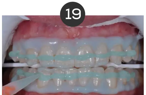 Teeth Whitening Instructions