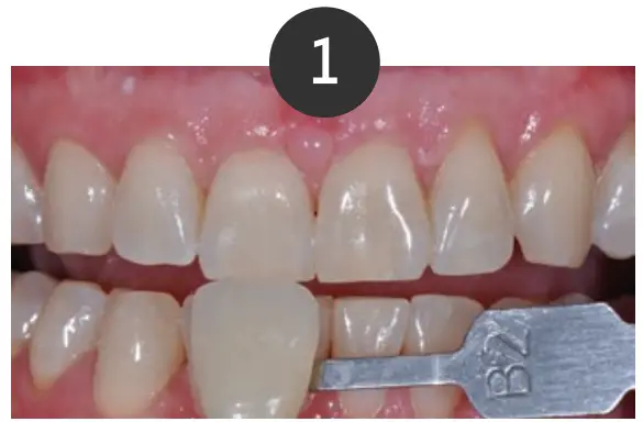 Whitening Instructions