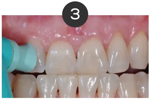 Whitening Instructions