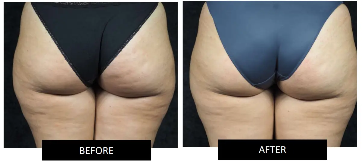 manicare 23118 Firming Body Sculptor - skin