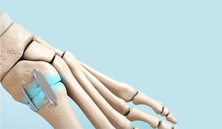 Djo Dynaclip Procedure Instructions Djo Dynaclip Procedure Instructions