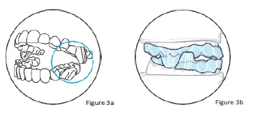 IFU-207020-Living-with-Invisalign-Clear-Aligners-FIG-2