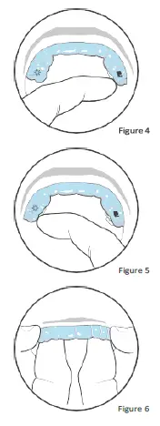 IFU-207020-Living-with-Invisalign-Clear-Aligners-FIG-3