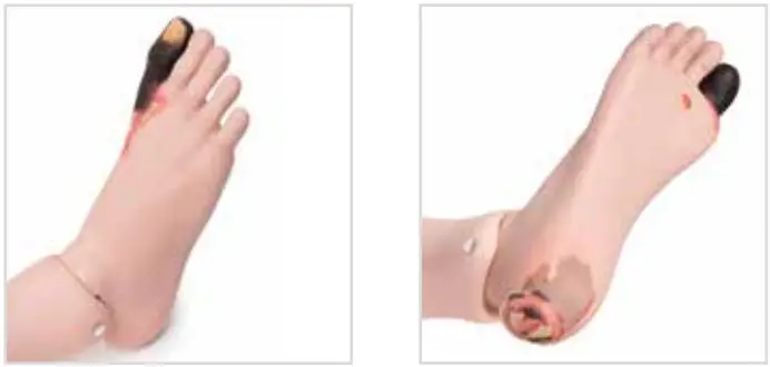 3B Nikki The Nursing Manikin With Auscultation - Diabetic Foot Syndrome