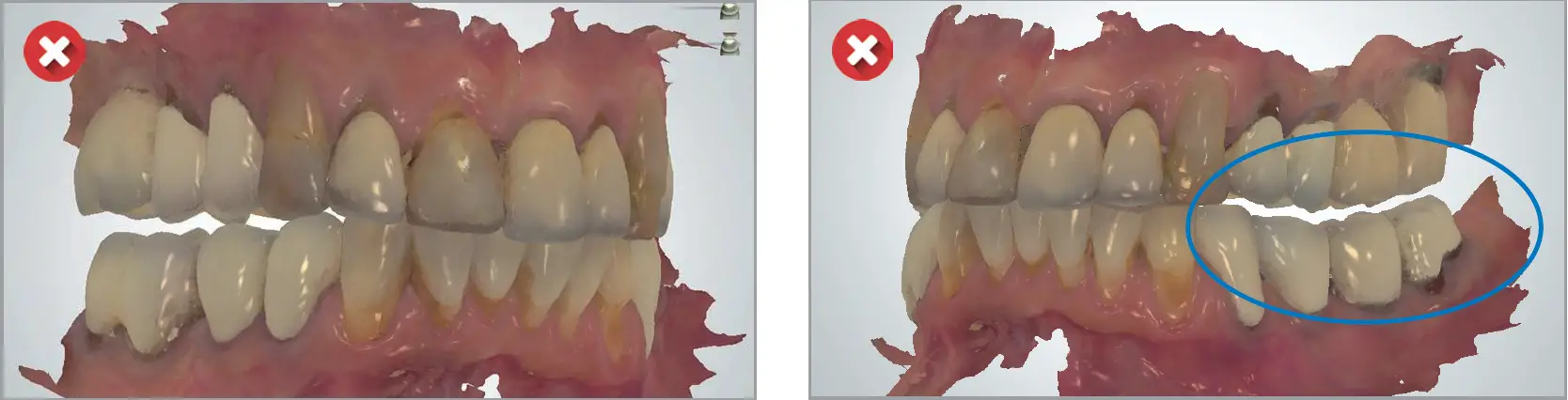 Incorrect scans linked to occlusion 01